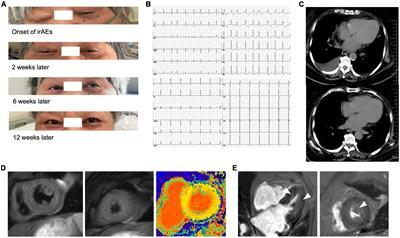 Myocarditis and myositis/myasthenia gravis overlap syndrome induced by immune checkpoint inhibitor followed by esophageal hiatal hernia: A case report and review of the literature